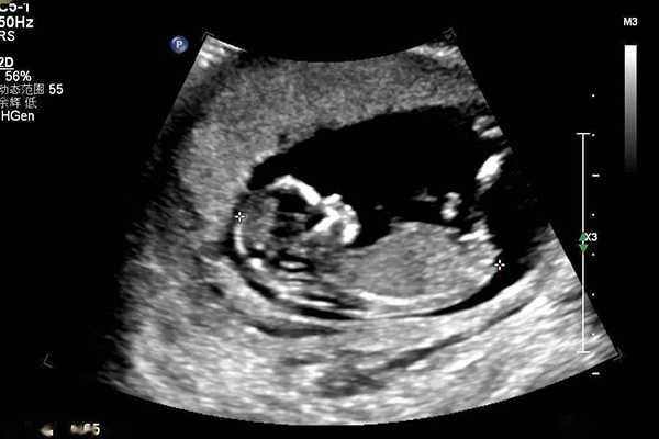 孕12周NT单上有男女标志，三个亮点是男孩女孩一